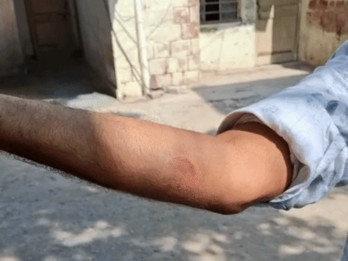 धौलपुर जेल में हिस्ट्रीशीटर ने मचाया उत्पात, प्रहरी को काटा:खाना बांटने के दौरान बंदियों से किया झगड़ा, बीच-बचाव करने पहुंचे प्रहरियों से की मारपीट